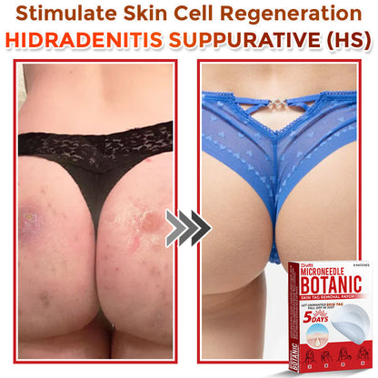 Divifit MicroNeedle Botanic Skin Tag Removal Patch 🇺🇸 Made in the USA