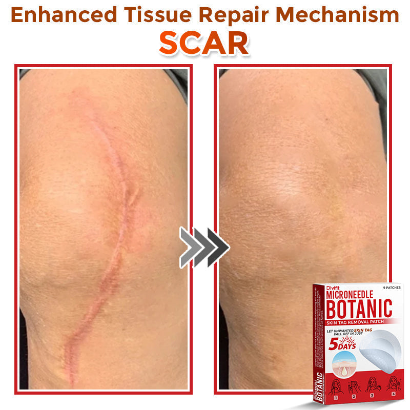 Divifit MicroNeedle Botanic Skin Tag Removal Patch 🇺🇸 Made in the USA