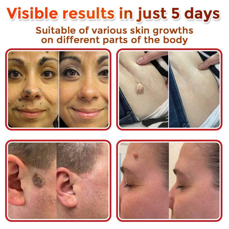 Divifit MicroNeedle Botanic Skin Tag Removal Patch 🇺🇸 Made in the USA