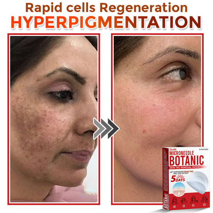 Divifit MicroNeedle Botanic Skin Tag Removal Patch 🇺🇸 Made in the USA